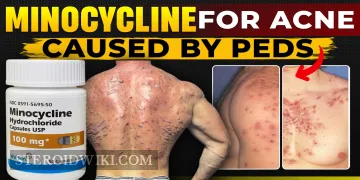 Minocycline for Acne Caused by PEDs