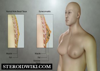 Treating Gynecomastia (Man Boobs)